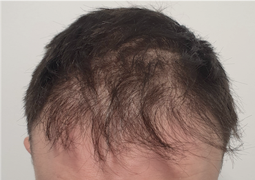 hair transplant 5 - before