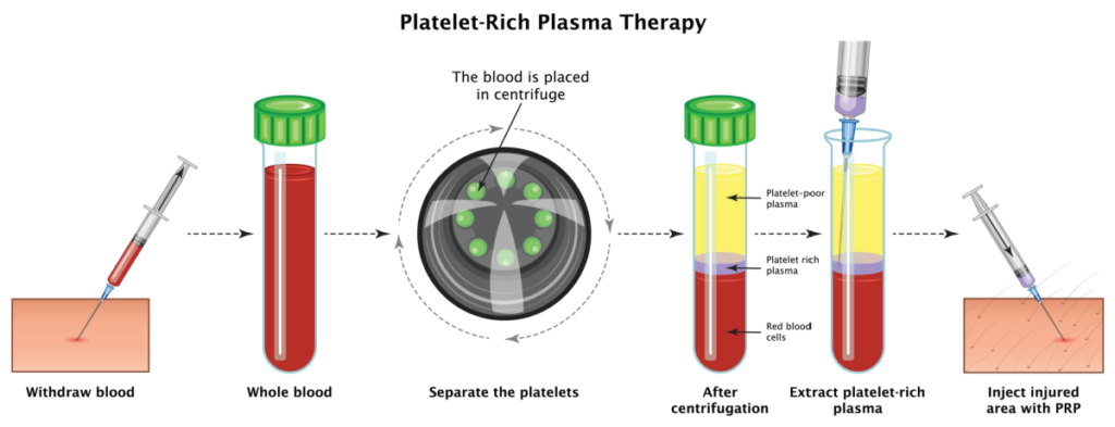 prp-hair-loss-treatment